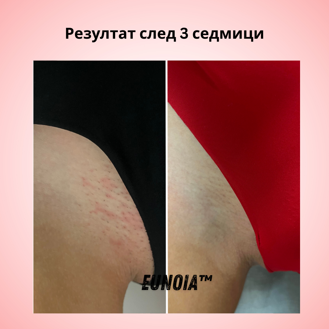 Eunoia® Нежна грижа за чувствителната зона