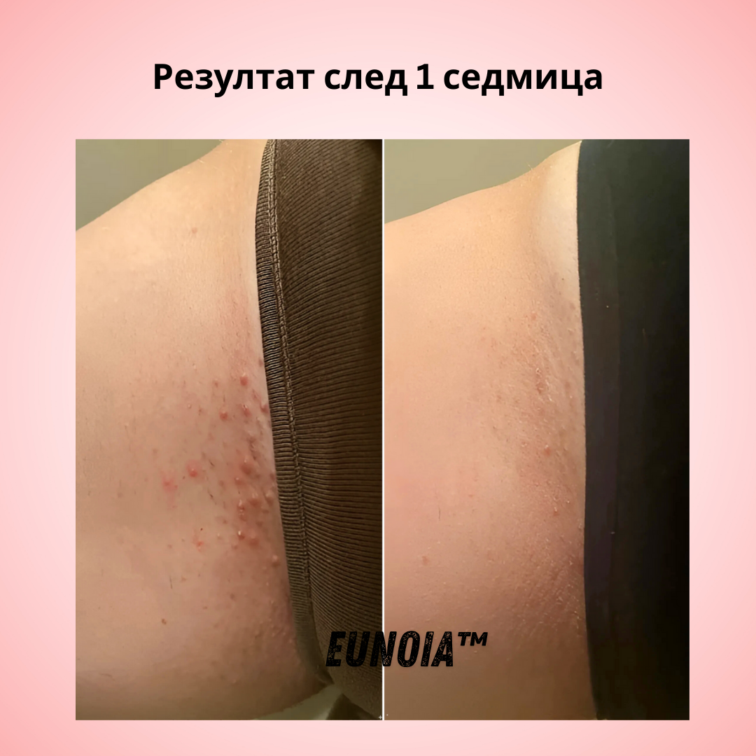 Eunoia® Нежна грижа за чувствителната зона