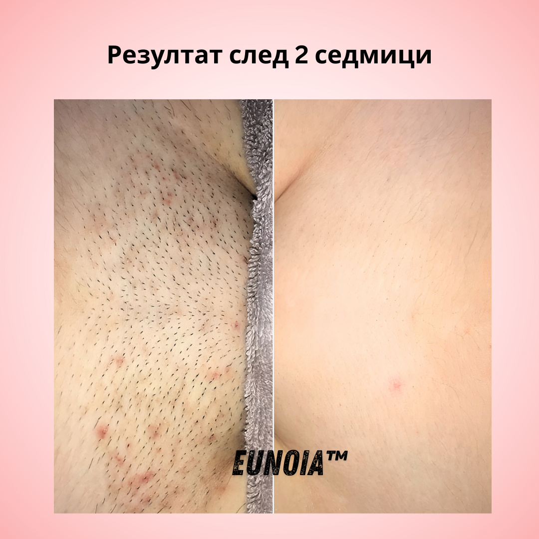 Eunoia® Нежна грижа за чувствителната зона